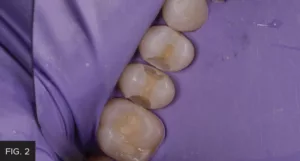 decay mesial of tooth #13