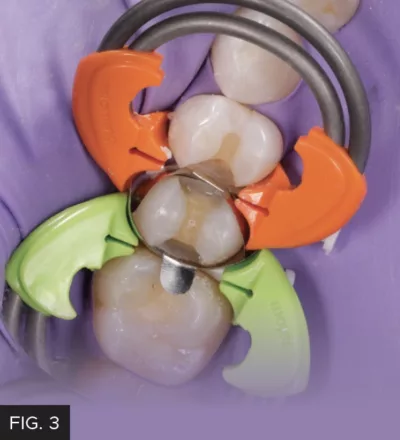 DualForce Matrix System, mesial, distal tooth, pre-contoured matrix bands