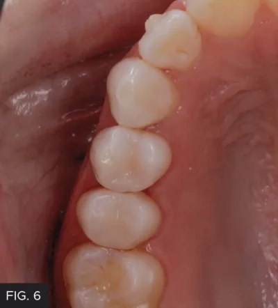 post-operation,clincal results, Class II