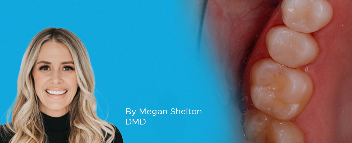 Dr. Megan Shelton Class II Composite article banner