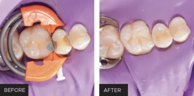 Class II restoration, DualForce sectional matrix system, clinical