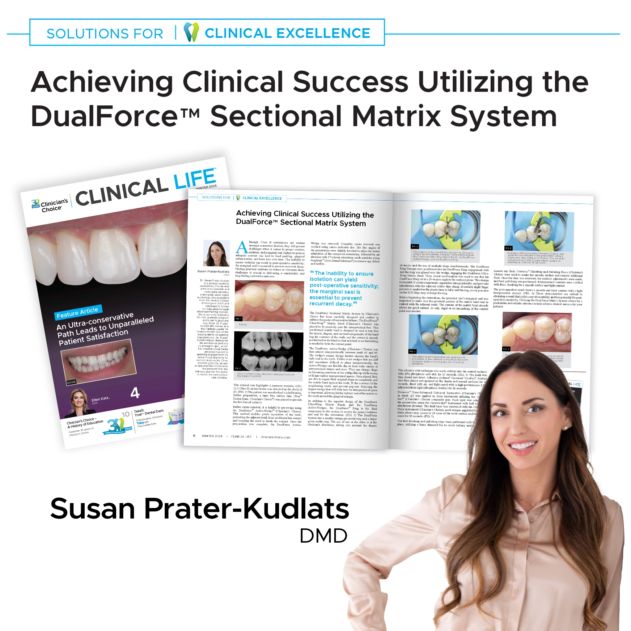 social thumbnail Clinical Life article Dr. Prater DualForce Sectional Matrix System