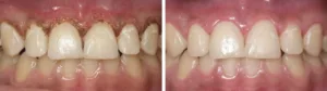 clinical gingivectomy, gingivoplasty