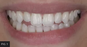 intraoral mock-up