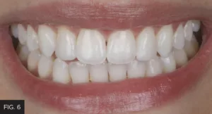 new smile, final restoration, anterior esthetics, composite dentistry