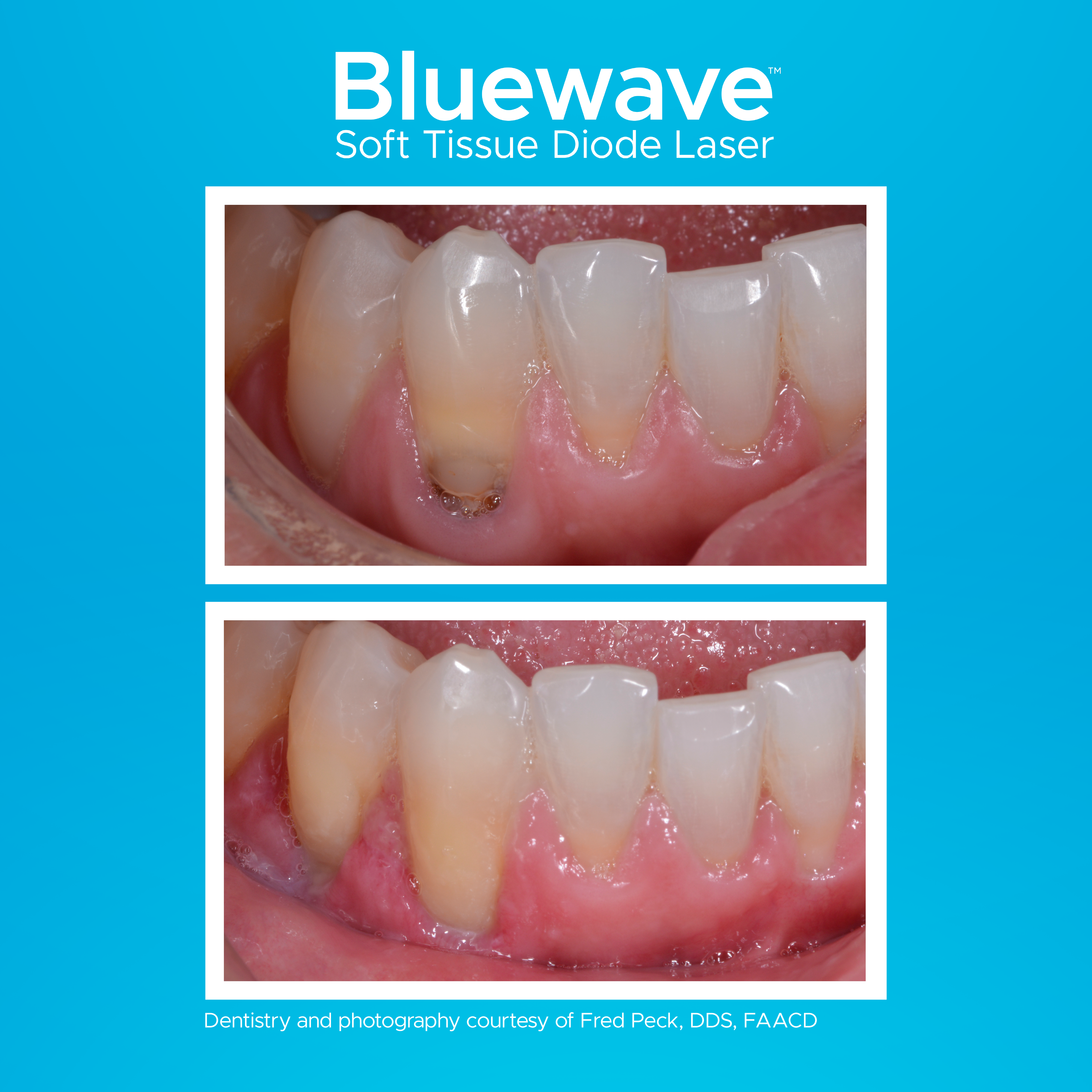 social thumbnail - Treating Decay Subgingivally laser