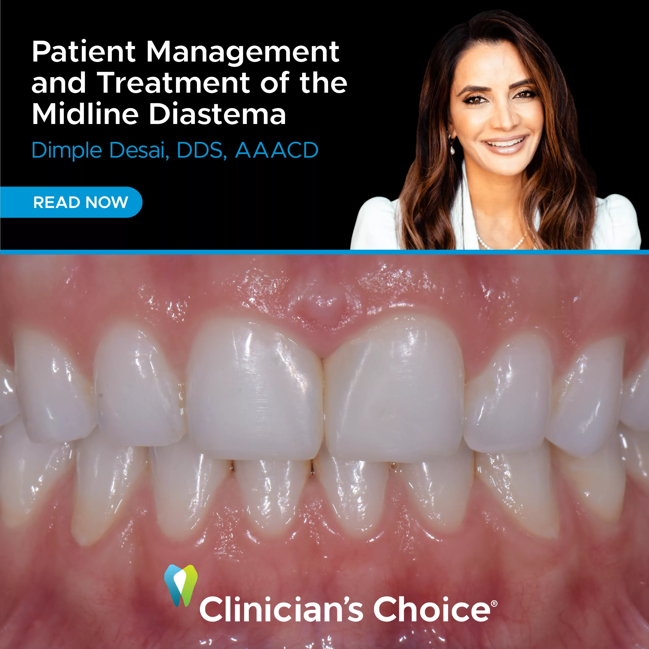 social thumbnail Dr. Dimple Desai article Patient Managfement midline diastema