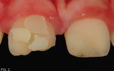 clinical image, composite resin shades, tooth color